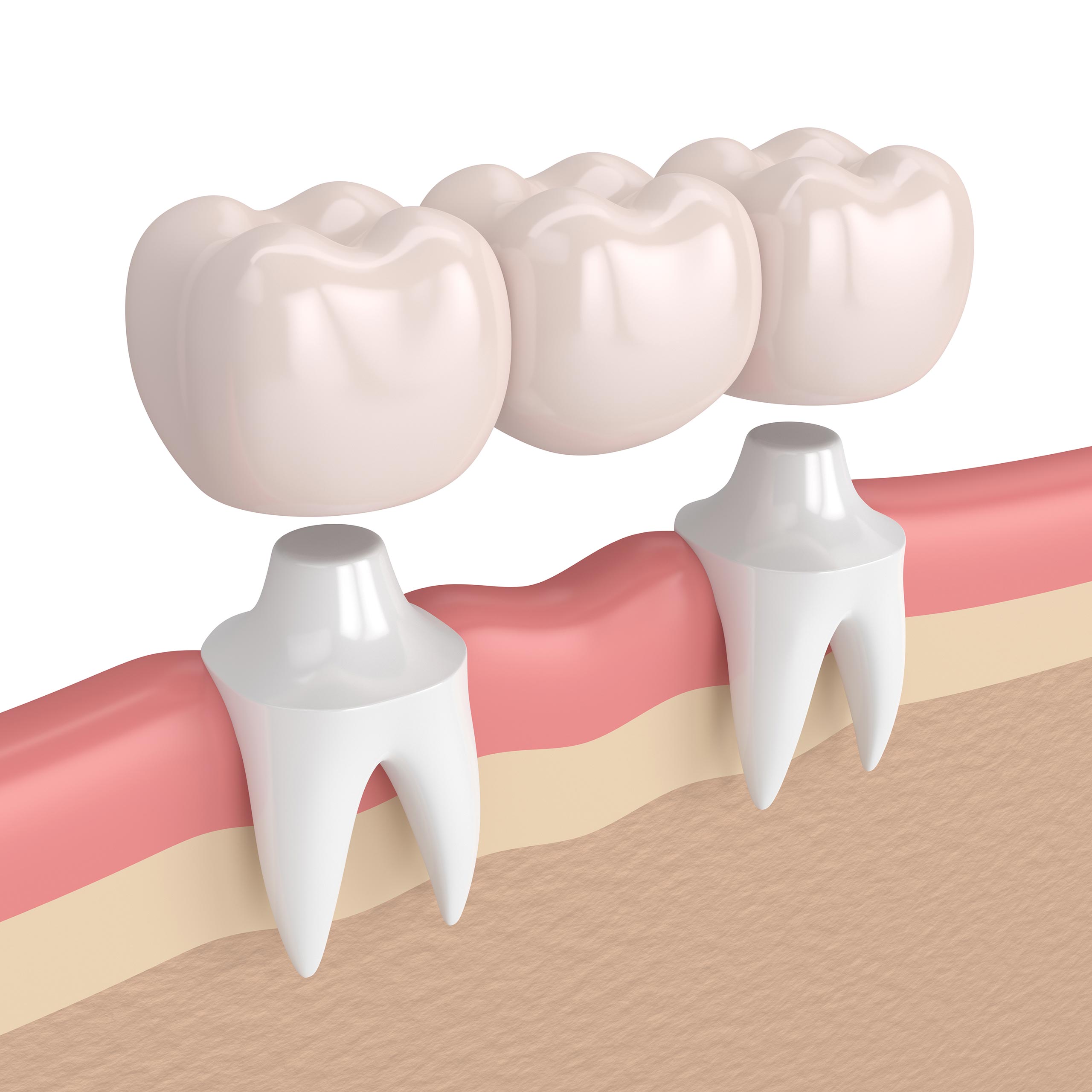 dental-bridge-tooth-crowns-bridges-auckland-cm-dental